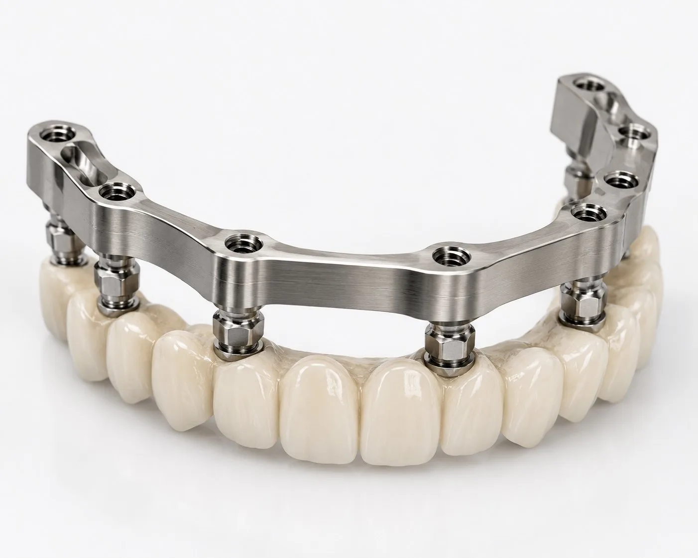Screw-Retained Restorations Over Implants With a Titanium Bar Framework