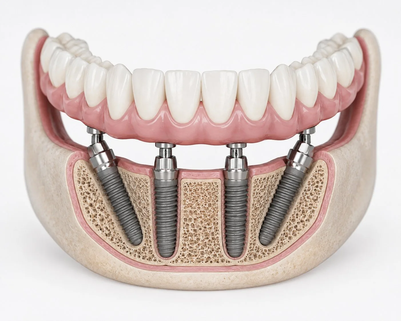 All-on-4: A Full Arch on Four Implants